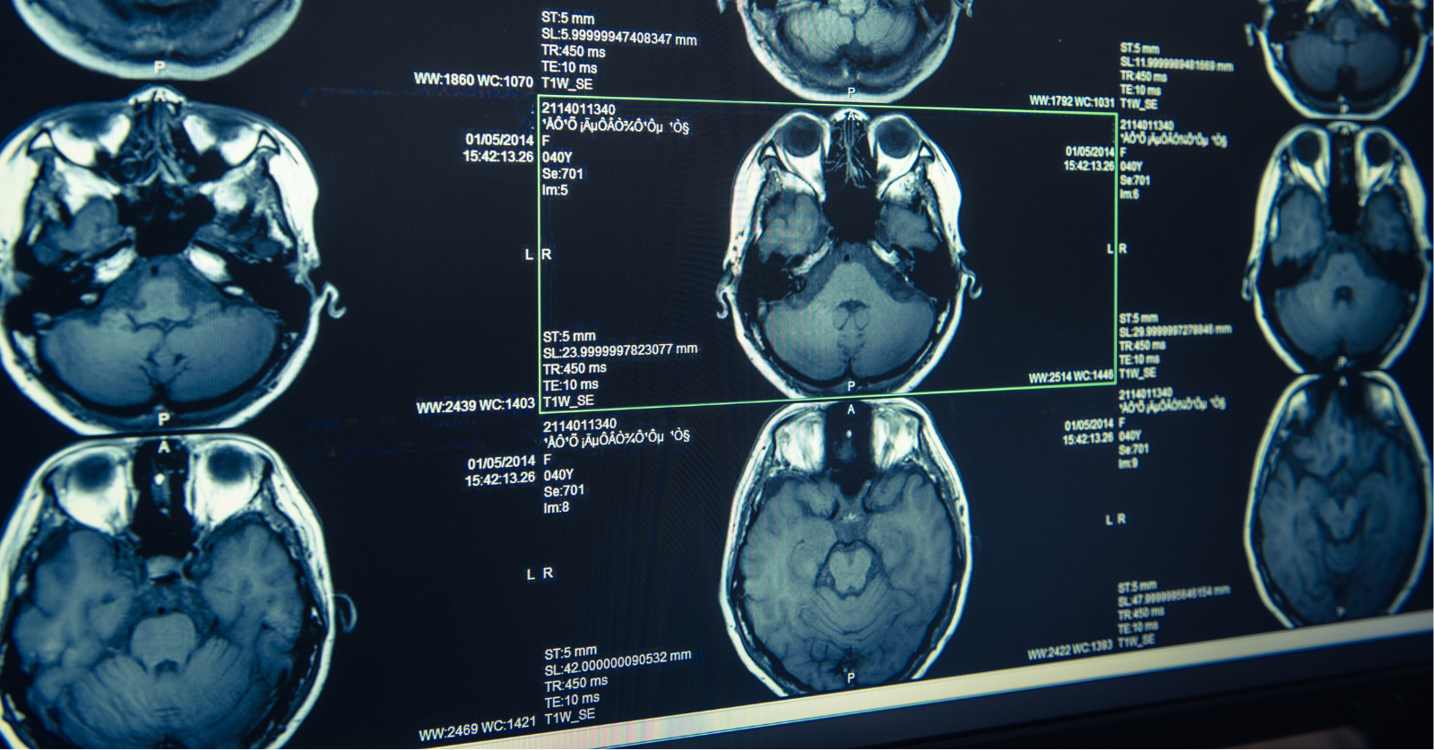 Ultrasound technology and brain implants offer new hope for those battling addiction